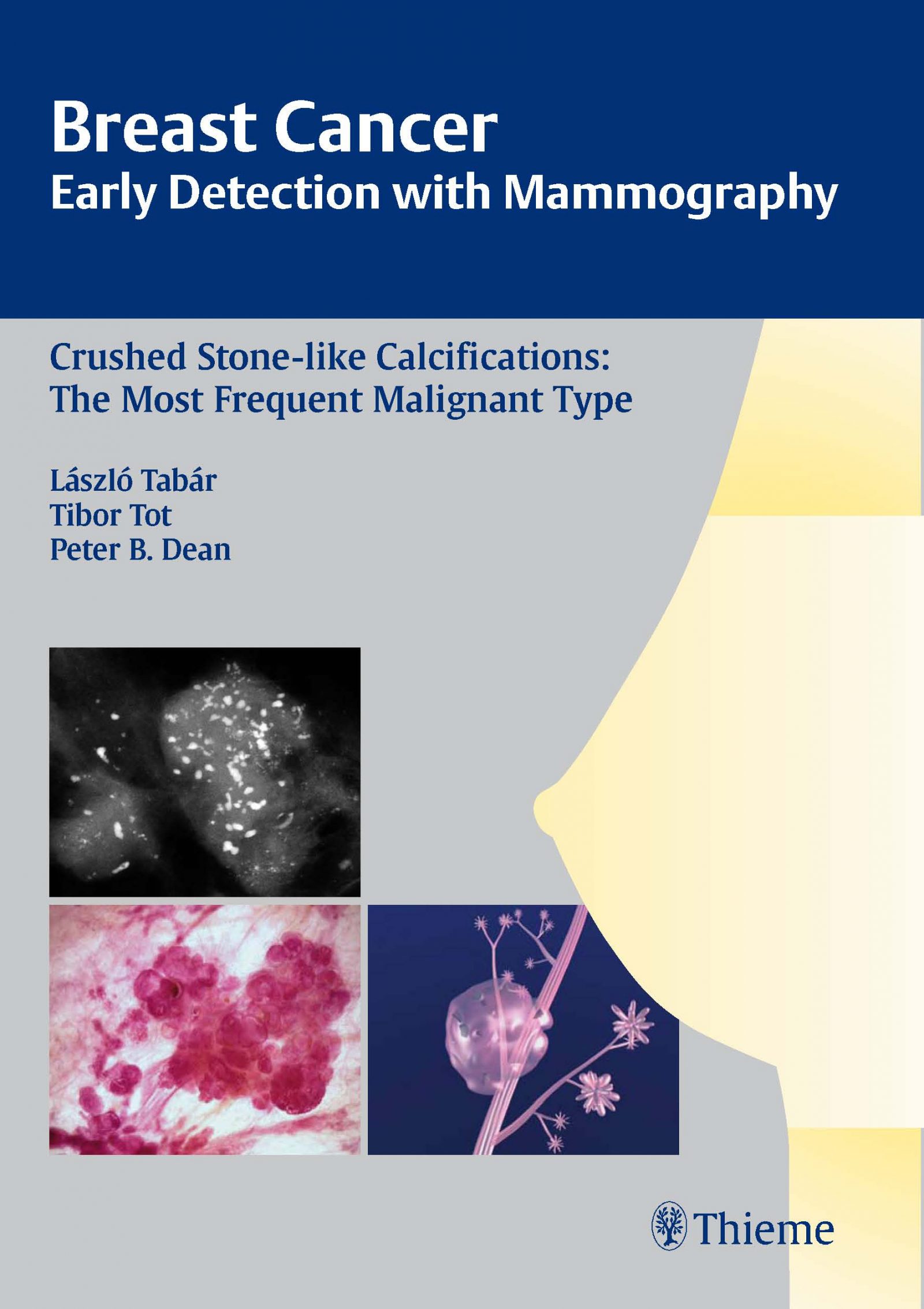 Breast Cancer. Early detection with Mammography. Crushed stone-like ...